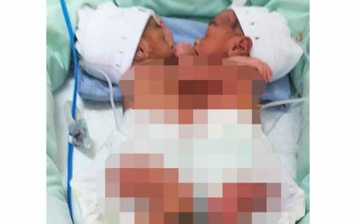 Bayi Kembar Siam Lahir di RS Adam Malik Medan