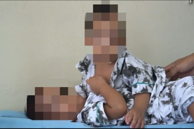 Besok, RS Adam Malik Kembali Operasi Pemisahan Bayi Kembar Siam