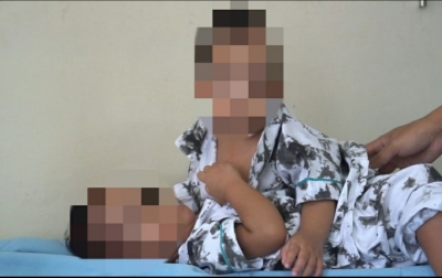 50 Tenaga Medis Dilibatkan Dalam Operasi Bayi Kembar Siam di RS Adam Malik