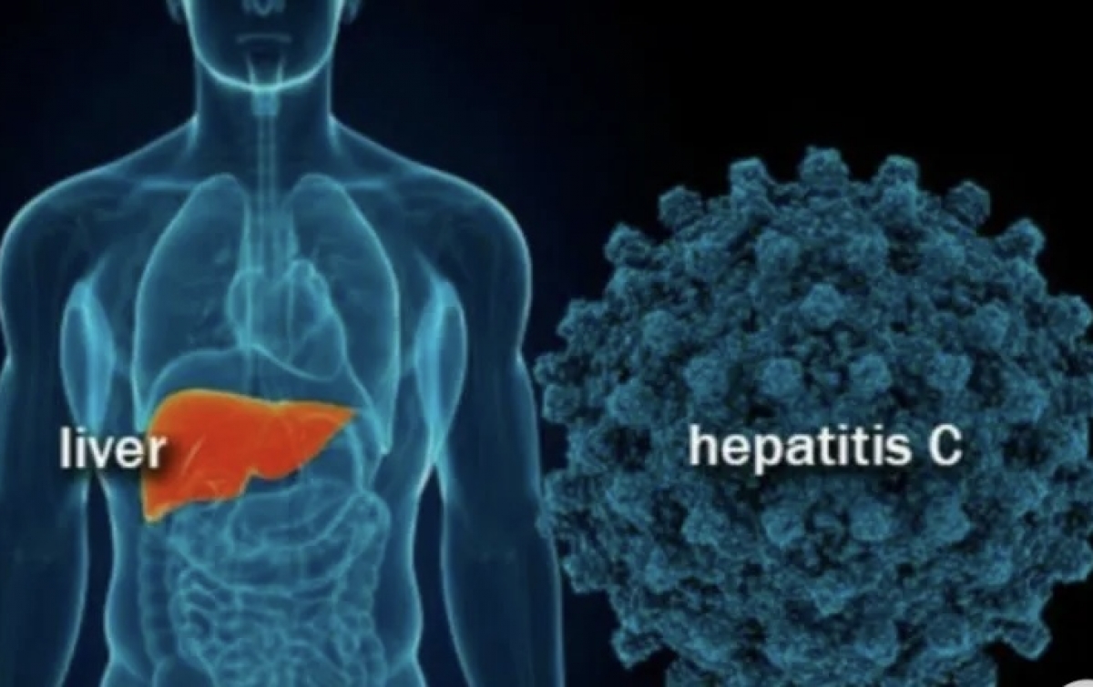 Indonesia Tingkatkan Kewaspadaan Hepatitis Akut Misterius pada Anak
