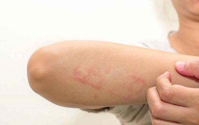Cara Mengatasi Kondisi Dermatitis Atopik dengan Mudah