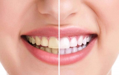 Cara Memutihkan Gigi Kuning