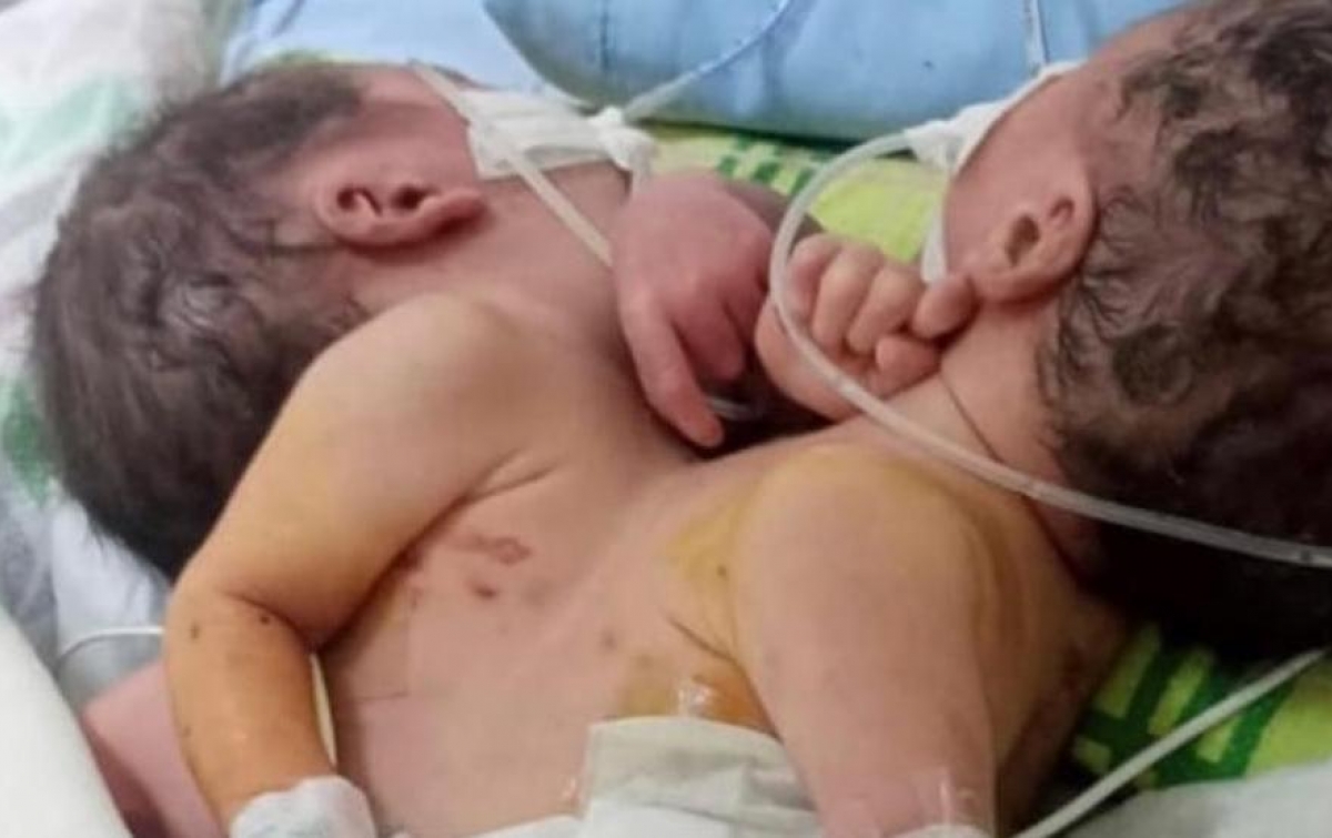 Lahir Dempet Dada, Bayi Kembar Siam Asal Batubara Butuh Bantuan Dermawan