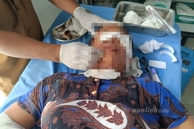 Wanita Paruh Baya Disiram Air Keras, Diduga Dipicu Dendam Pelaku