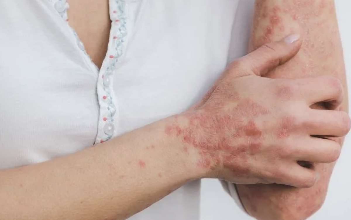 Catat, Stres dan Cuaca Bisa Picu Psoriasis