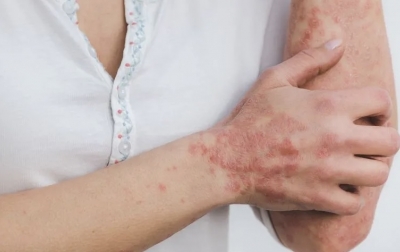 Catat, Stres dan Cuaca Bisa Picu Psoriasis