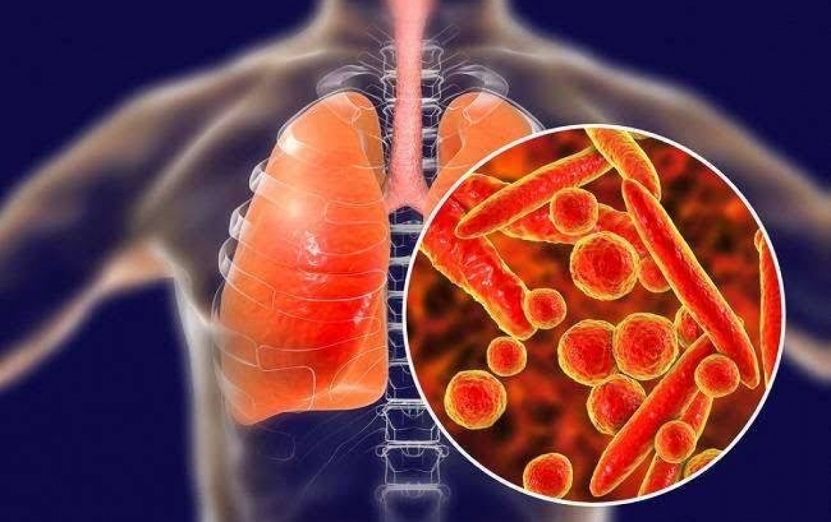 Dinkes Medan Imbau Masyarakat Waspadai Peningkatan Kasus Covid-19 dan Mycoplasma Pneumonia