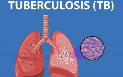 Tuberkulosis Dapat Dicegah dan Diobati dengan Terapi Pencegahan
