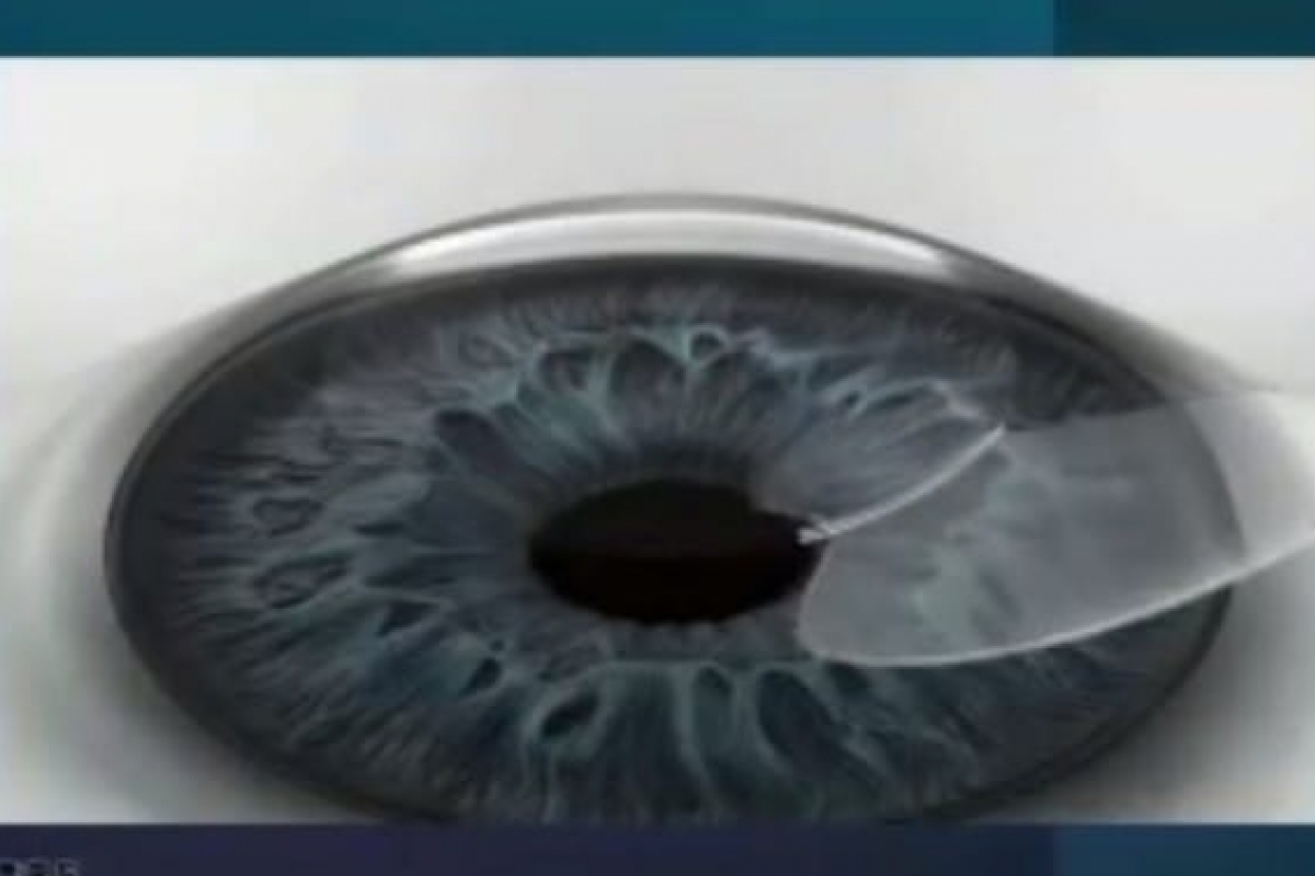 SiLK, Teknologi LASIK Terbaru Tanpa Flap