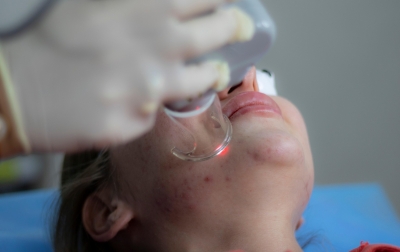 Hindari Makanan Ini! Agar Kulit Terbebas Dari Jerawat