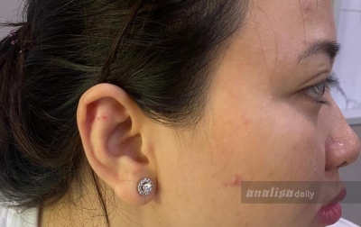 Dokter Kecantikan Jadi Korban Penganiayaan Sadis oleh Kakak Kandung Sendiri di Medan