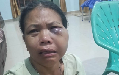 Mata Lebam, Gustina Sagala Kabur Dilempari Suami Pakai Kelapa di Lae Itam Dairi