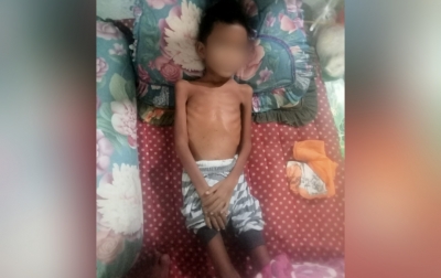 Bocah 10 Tahun di Natal Bertubuh Sangat Kurus, Kades: Bukan Gizi Buruk