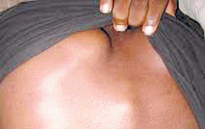 mengenal-potts-disease